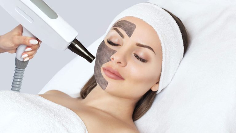carbon peel